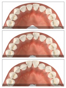 występujące zęby - clear aligner