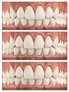 rozbieżne zęby - clear aligner