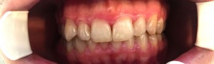 clear aligner pierwszy miesiac